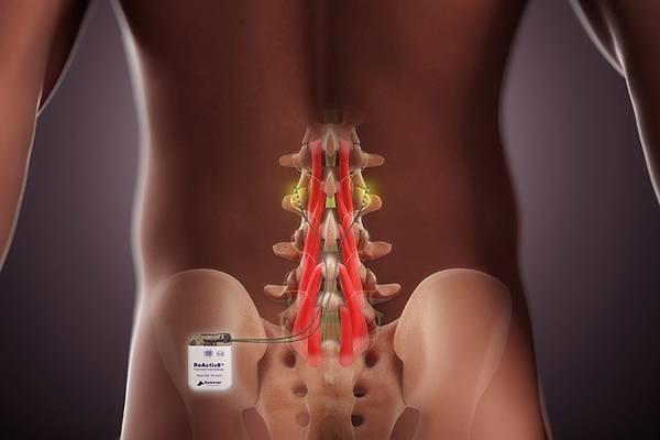 Mainstay Medical targets US back pain market