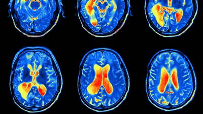 Public patient waits 120 days more than private one for brain scan